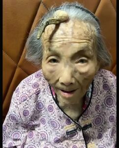 “This is too risky”: 107YO went viral because the 4-inch “Longevity Horn” growing on her forehead was said to be due to… see more