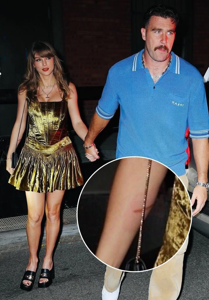 Fans recently spotted Taylor Swift’s noticeable injury in photos with Travis Kelce – Is she suffering from something? -baro